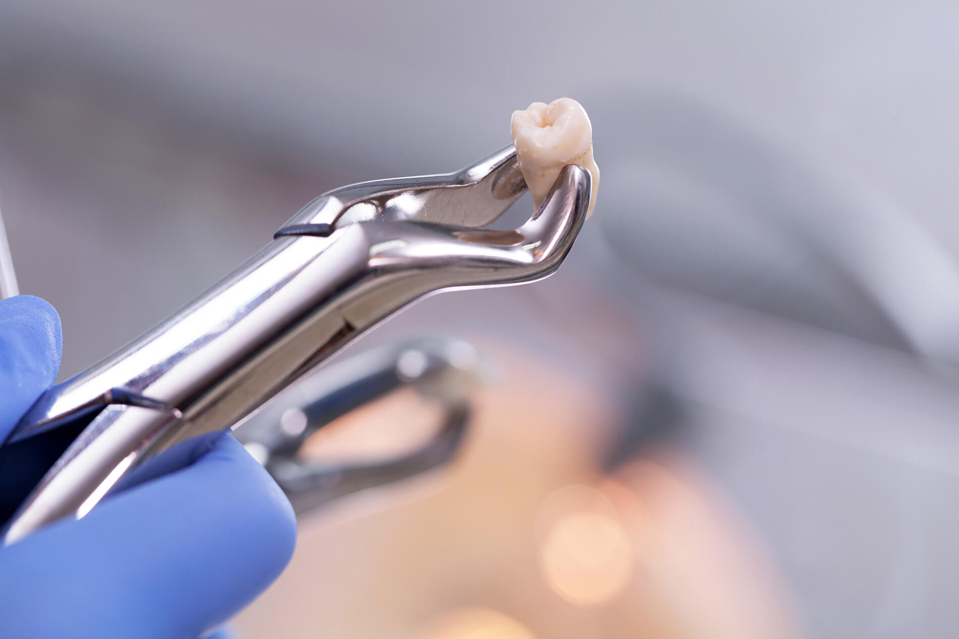 Pearland Tooth Extraction